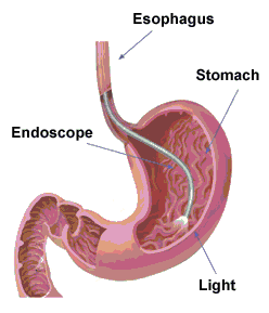 endoscope exam